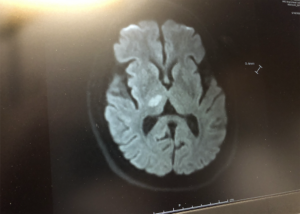 The white area in the center of the picture above is the damaged brain area caused by Mike Rhodes' ischemic stroke in 2020. Photo by Mike Rhodes