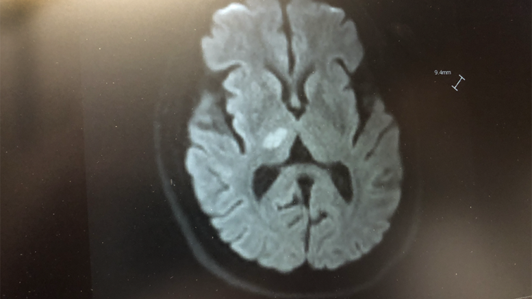 The white area in the center of the picture above is the damaged brain area caused by Mike Rhodes' ischemic stroke in 2020. Photo by Mike Rhodes