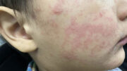 Measles: What Our Community Should Know