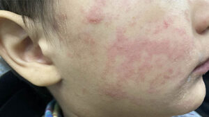 This child’s cheek shows the characteristic rash associated with measles. Photo provided by the Centers for Disease Control and Prevention.