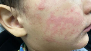 This child’s cheek shows the characteristic rash associated with measles. Photo provided by the Centers for Disease Control and Prevention.